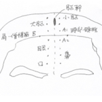 顔面痙攣の針治療
